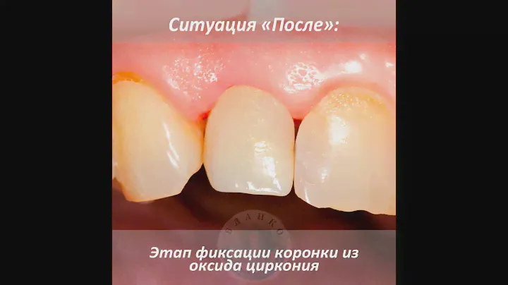 Восстановление зуба с помощью стекловолоконного штифта и коронки из оксида циркония
